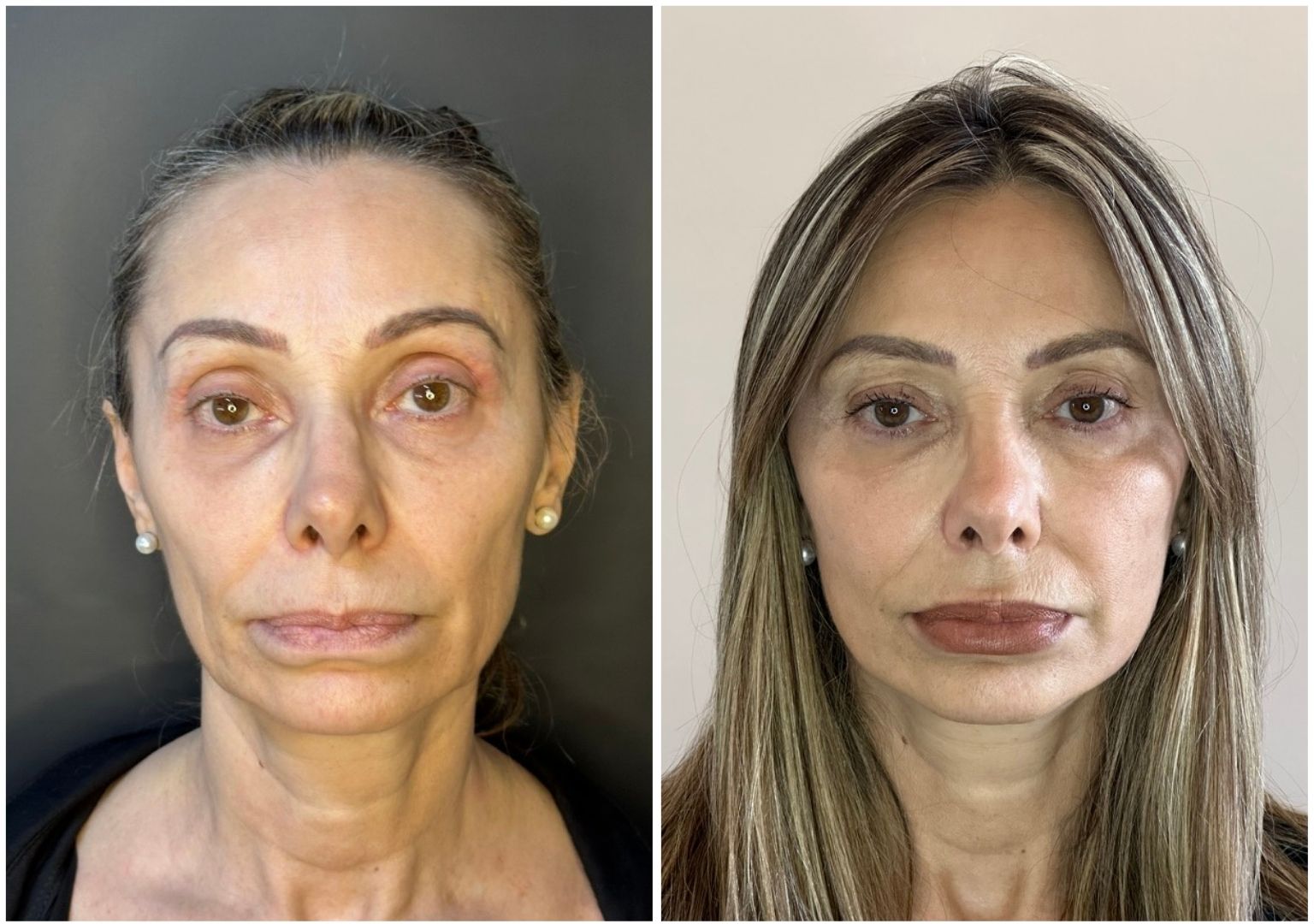 Cirugia plastica facial antes y despues
