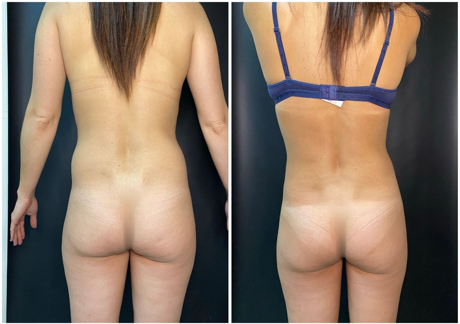 Cirugia Plastica Corporal