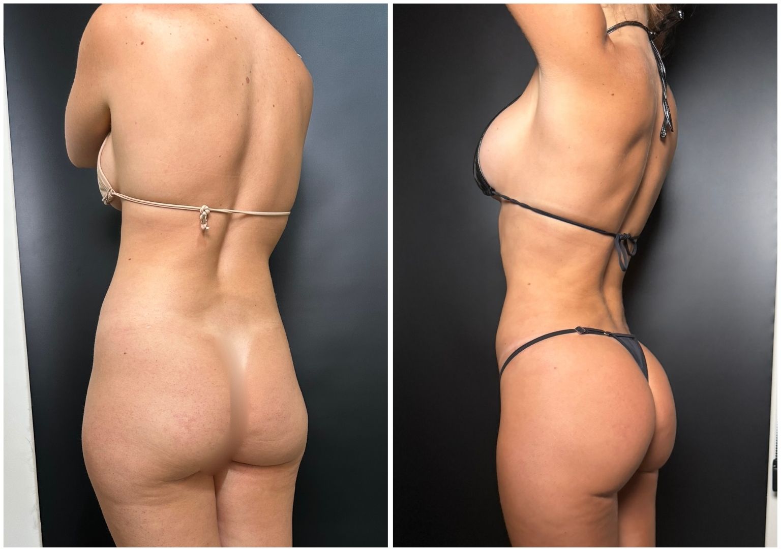 Cirugia Plastica Corporal