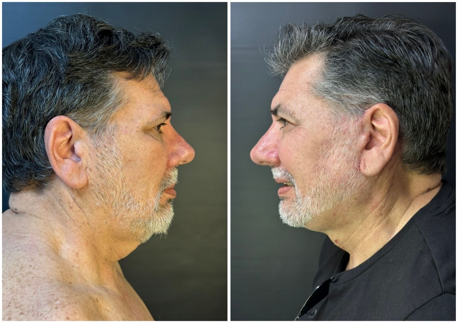 Cirugia plastica facial antes y despues