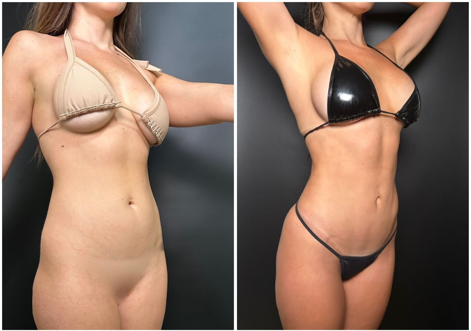 Cirugia Plastica Corporal