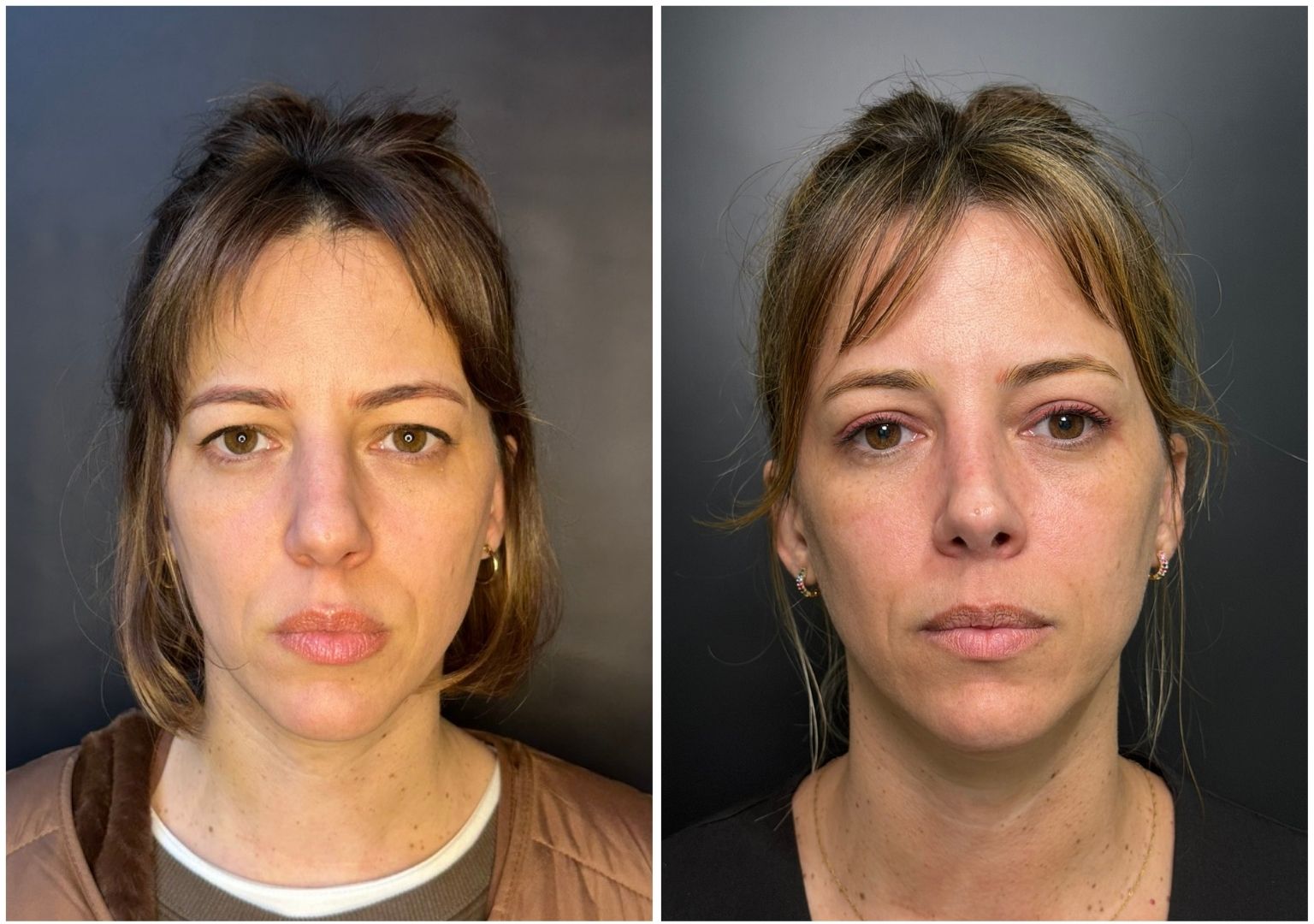 Cirugia plastica facial antes y despues