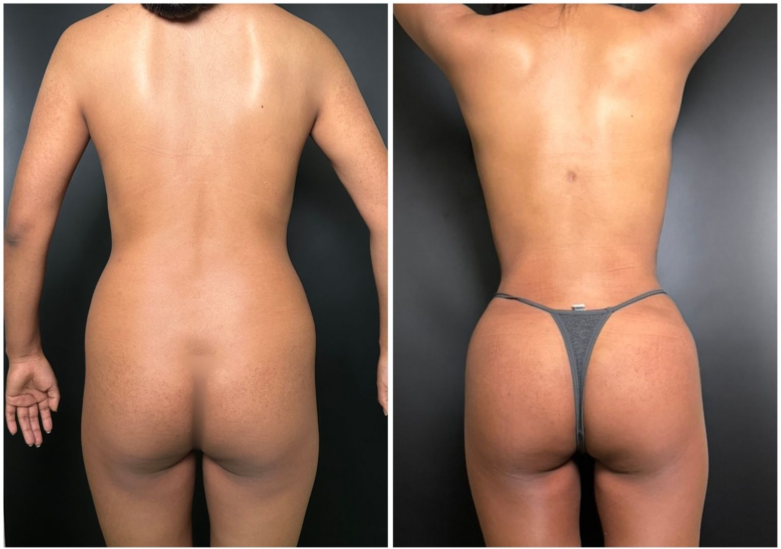 Cirugia Plastica Corporal