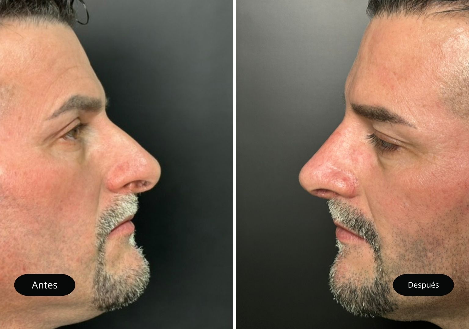 rinoplastia antes y despues