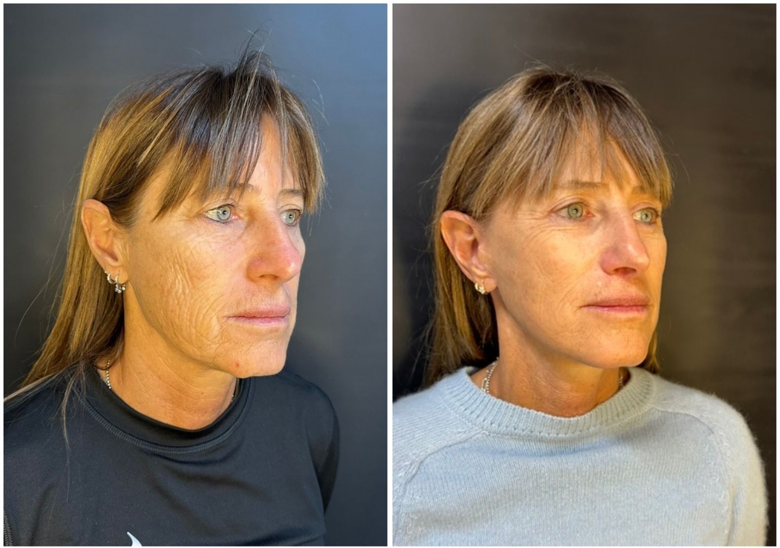 Cirugia plastica facial antes y despues