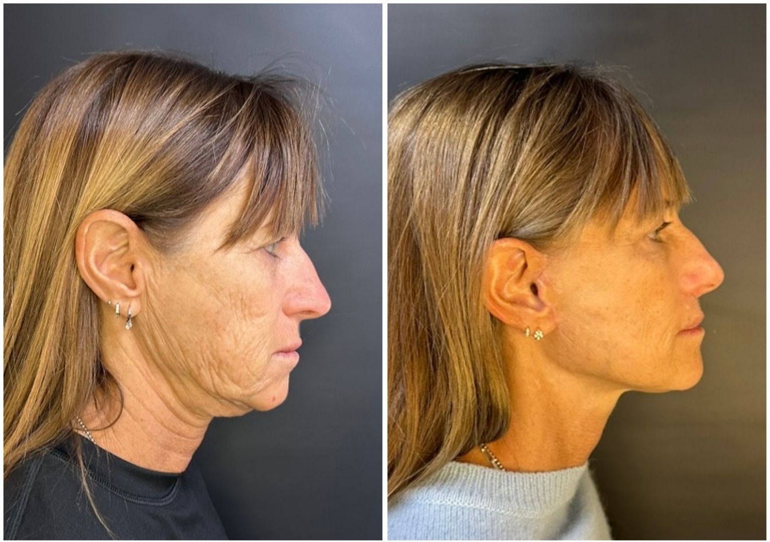 Cirugia plastica facial antes y despues