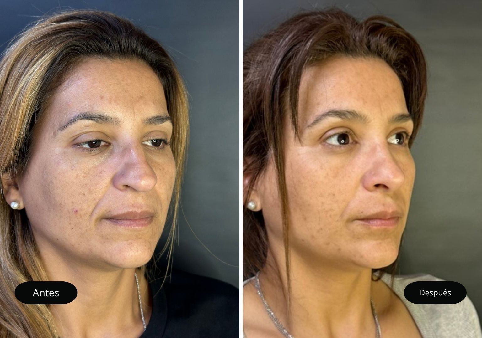 antes y despues de rinoplastia