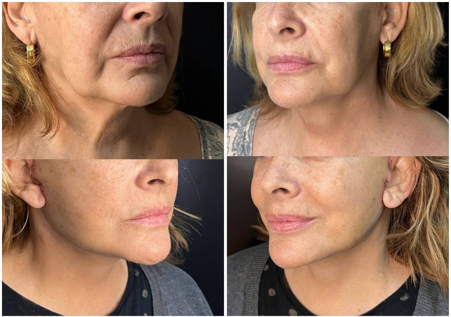 Cirugia plastica facial antes y despues