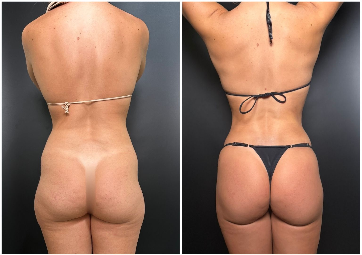 Cirugia Plastica Corporal