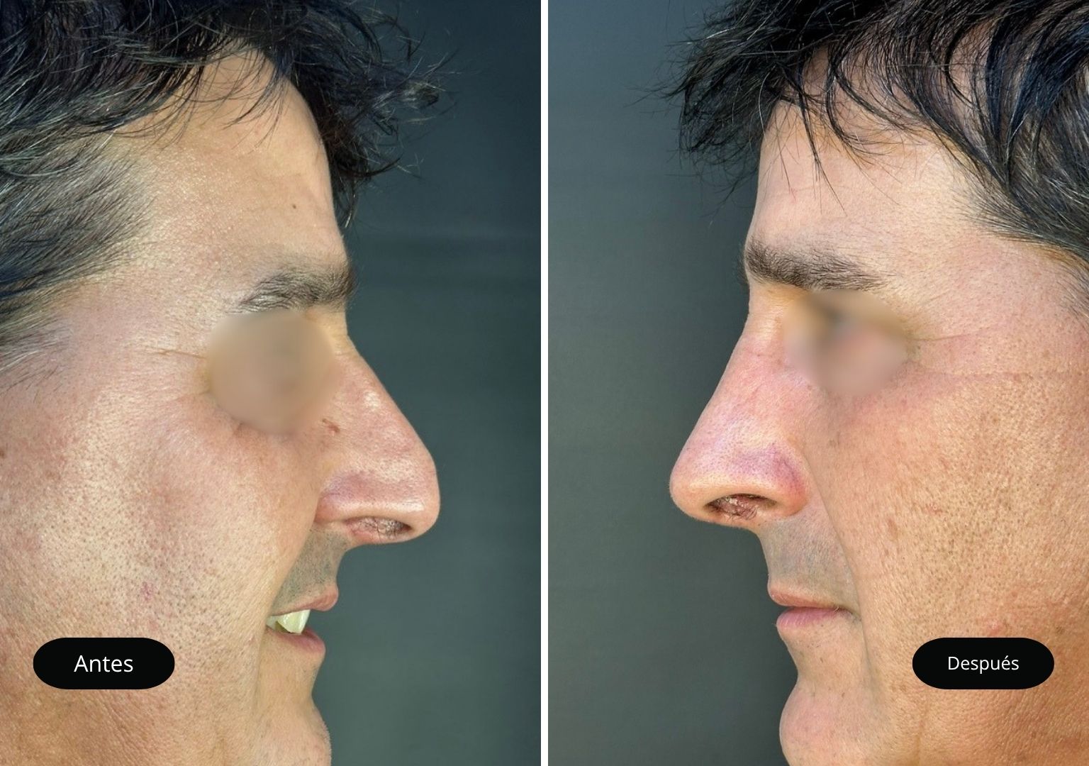1 Tinoplastia 1