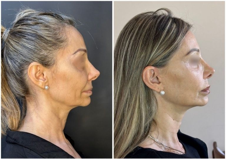 cirugia plastica facial