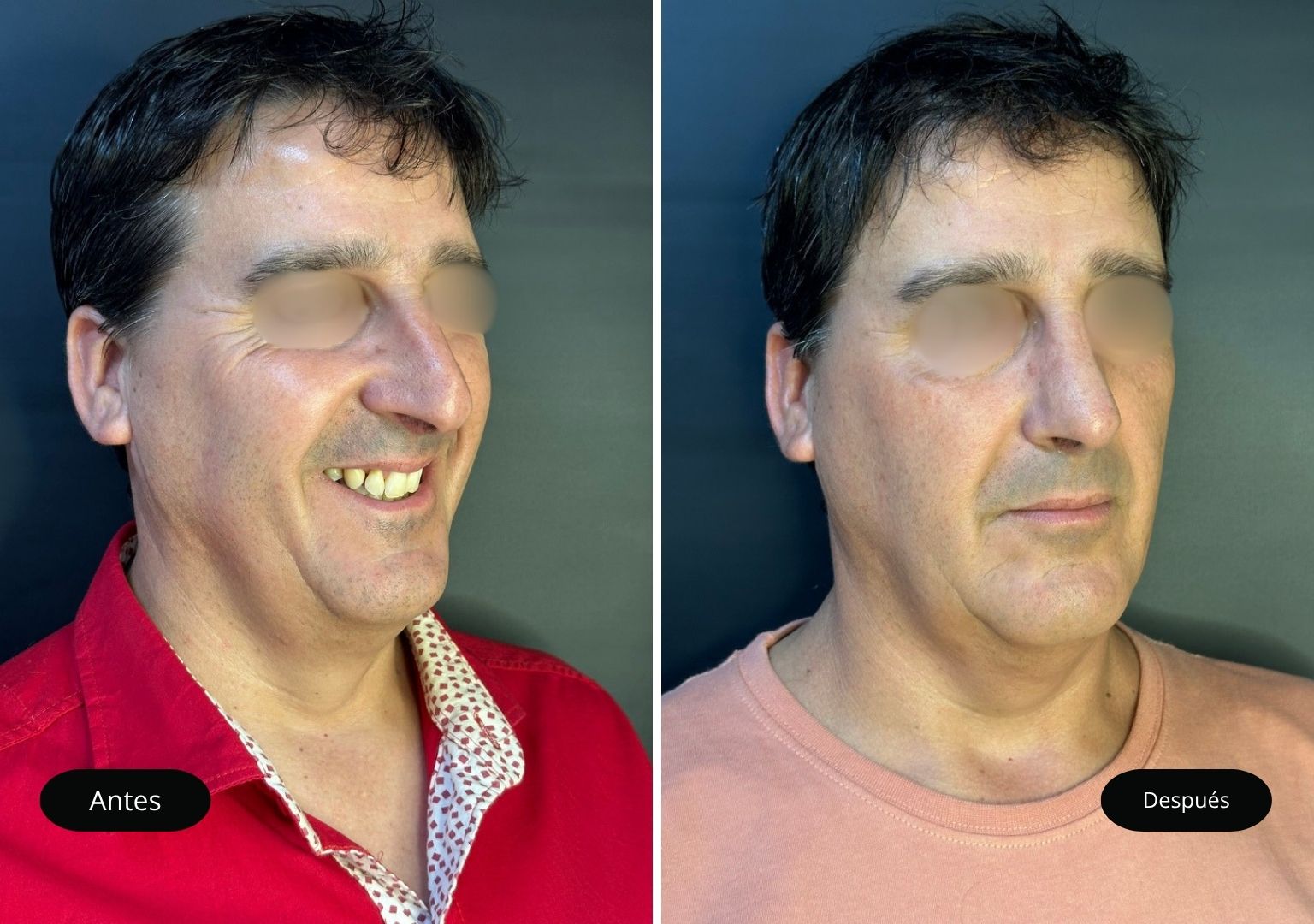 2 Tinoplastia 2