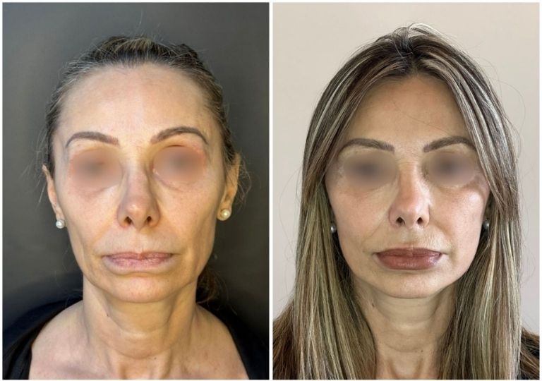 Cirugia plastica facial antes y despues