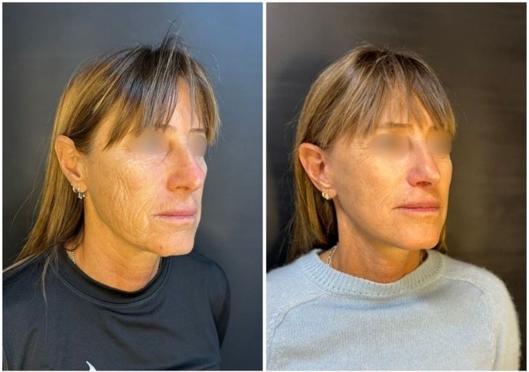 cirugia plastica facial