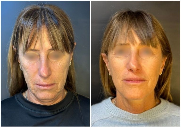 cirugia plastica facial