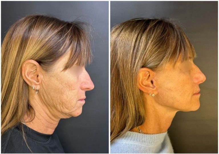 cirugia plastica facial