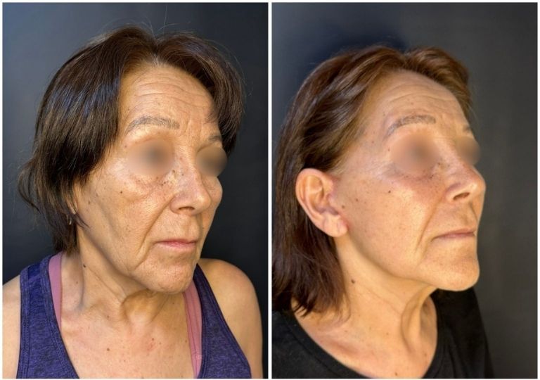 Cirugia plastica facial antes y despues
