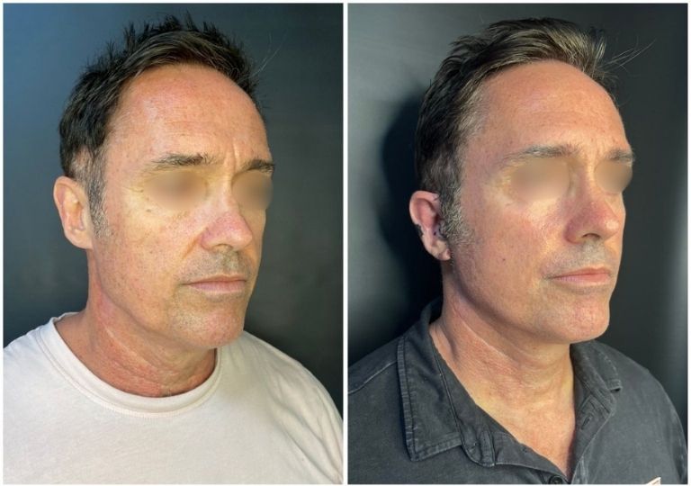 cirugia plastica facial