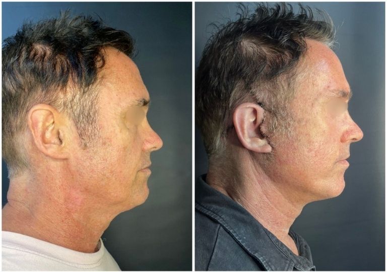 cirugia plastica facial