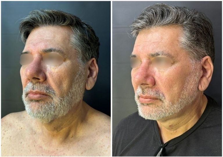 Cirugia plastica facial antes y despues
