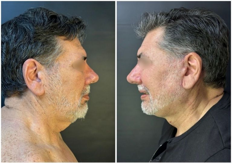 cirugia plastica facial