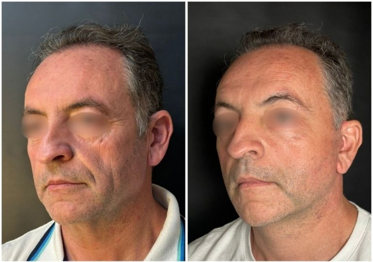 cirugia plastica facial