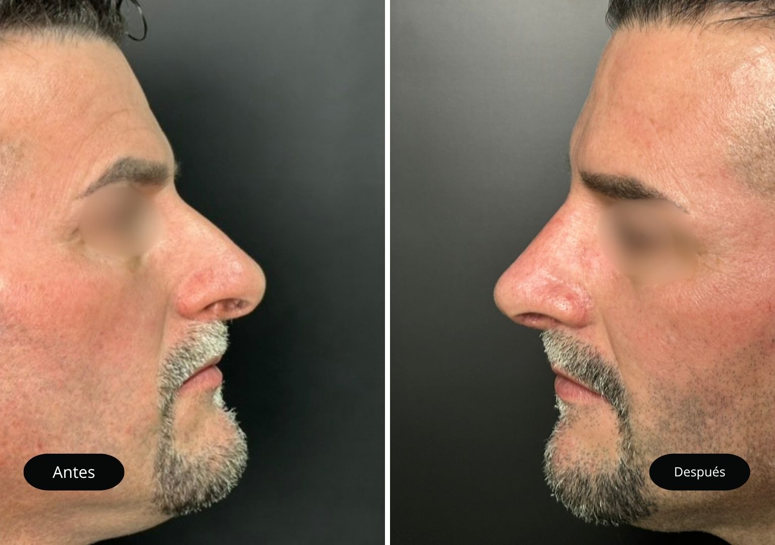 3 Tinoplastia 3