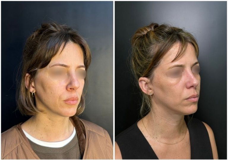 cirugia plastica facial