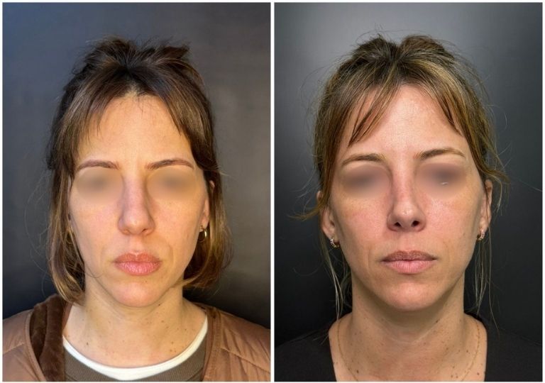 cirugia plastica facial