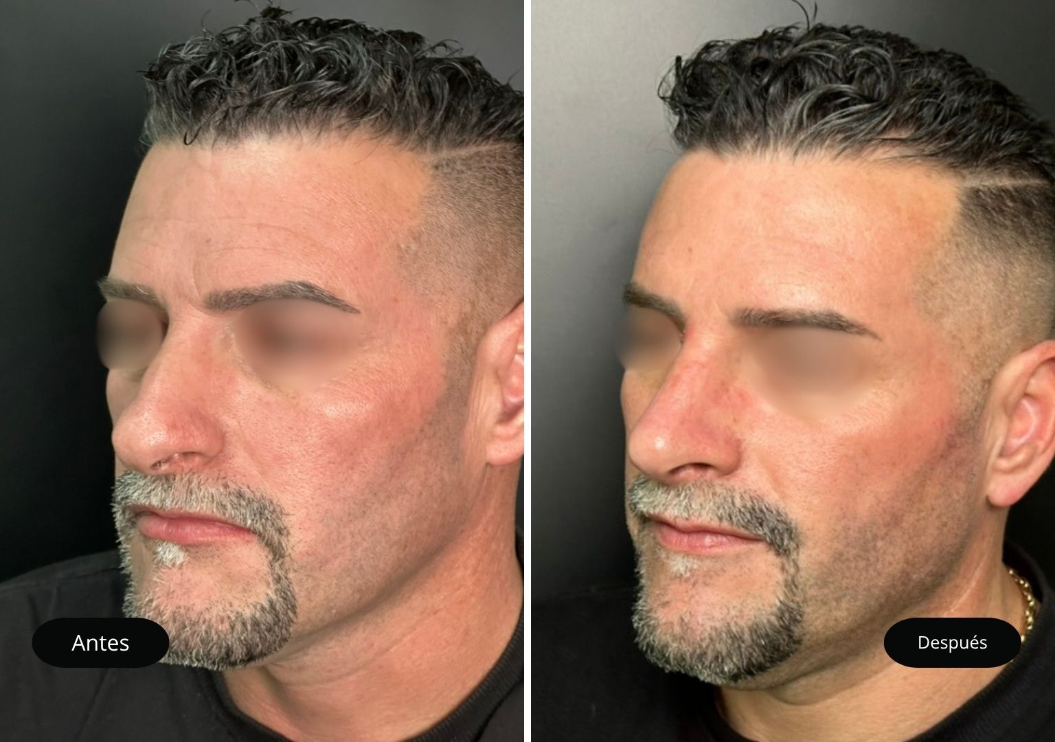 4 Tinoplastia 4