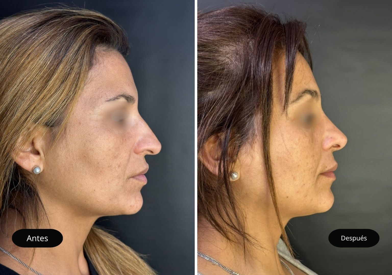 5 Tinoplastia 5