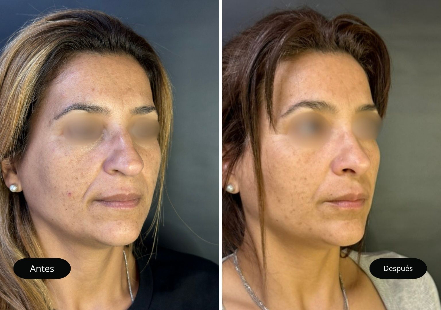 6 Tinoplastia 6