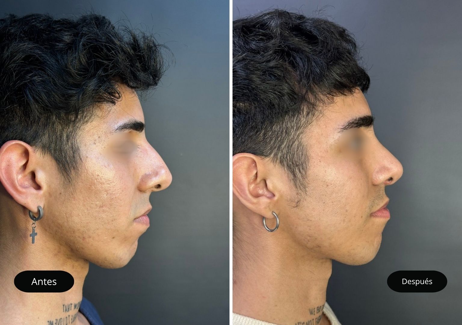 7 Tinoplastia 7