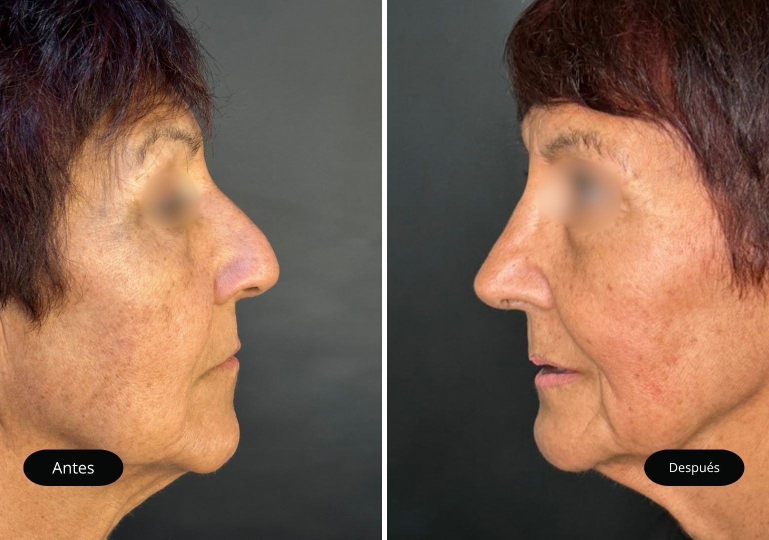 8 Tinoplastia 8